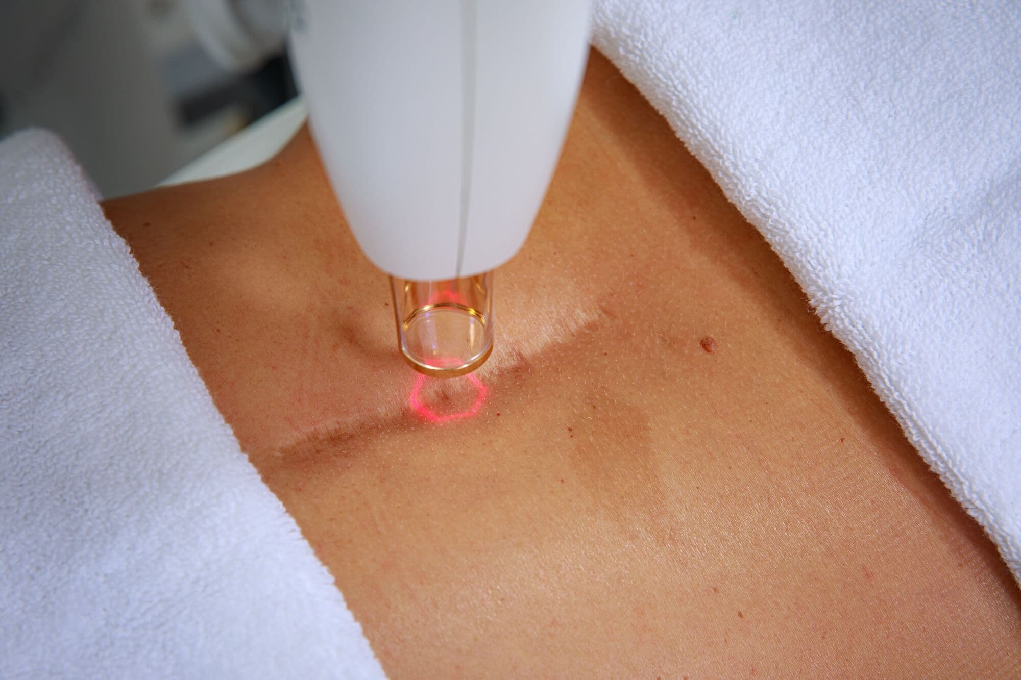 Премахване на белези с Lumenis Stellar M22 ResurFX